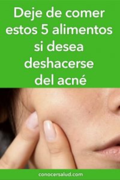 Alimenti che possono peggiorare l'acne