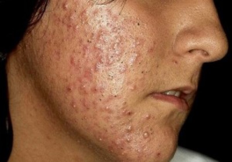 Traitements médicaux de l'acné sévère